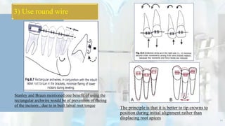 Stanley and Braun mentioned one benefit of using the
rectangular archwire would be of prevention of flaring
of the incisors , due to in built labial root torque
The principle is that it is better to tip crowns to
position during initial alignment rather than
displacing root apices
3) Use round wire
10
 