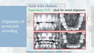 Alignment of
symmetric
crowding
Arch wire choices
Superelastic NiTi – ideal for initial alignment
19
•Wiiliam R Proffit textbook of comtemporary orthodontics Fifth edition
 