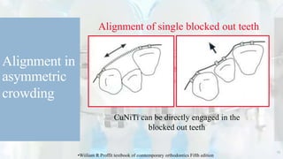 Alignment in
asymmetric
crowding
Alignment of single blocked out teeth
CuNiTi can be directly engaged in the
blocked out teeth
23
•Wiiliam R Proffit textbook of comtemporary orthodontics Fifth edition
 