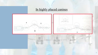 In highly placed canines
25
 