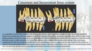 Consistent and Inconsistent force system
26
A, A maxillary second molar extruded with distal-crown tipping. Upon inserting a straight wire into the second molar tube
(black line) and placing a force to engage it to the other brackets (blue arrow), an intrusive (desired) force with a mesial-crown
tipping tendency (desired) is expected to occur. Because the estimated load system matches the one desired to correct the tooth,
the load system is called consistent. B, A maxillary second molar extruded with mesial-crown tipping. Upon inserting a
continuous arch into the second molar tube (black line) and placing a force to engage it to the other brackets (blue arrow), an
extrusive force (unwanted) with a distal-crown tipping tendency (desired) is expected to occur. Since the estimated load system
does not match the desired one to correct the second molar, the load system is termed inconsistent.
Shintcovsk et al Continuous arch and rectangular loops for the correction of consistent and inconsistent load systems in extruded and tipped maxillary second molars AJODO March 2018 Vol 153
Issue 3
 