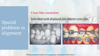 Special
problems in
alignment
Cross bite correction
Individual teeth displaced into anterior cross bite
27
•Wiiliam R Proffit textbook of comtemporary orthodontics Fifth edition
 