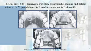 Skeletal cross bite - Transverse maxillary expansion by opening mid palatal
suture - 10- 20 pounds force for 2 weeks – retention for 3-4 months
28
•Wiiliam R Proffit textbook of comtemporary orthodontics Fifth edition
 
