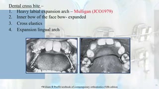 Dental cross bite –
1. Heavy labial expansion arch – Mulligan (JCO1979)
2. Inner bow of the face bow- expanded
3. Cross elastics
4. Expansion lingual arch
29
•Wiiliam R Proffit textbook of comtemporary orthodontics Fifth edition
 
