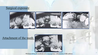 Surgical exposure
Attachment of the tooth
31
•Wiiliam R Proffit textbook of comtemporary orthodontics Fifth edition
 