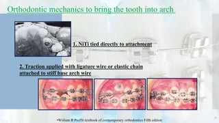 Orthodontic mechanics to bring the tooth into arch
1. NiTi tied directly to attachment
2. Traction applied with ligature wire or elastic chain
attached to stiff base arch wire
32
•Wiiliam R Proffit textbook of comtemporary orthodontics Fifth edition
 