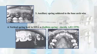 3. Auxiliary spring soldered to the base arch wire
4. Vertical spring bent in 0.014 ss (ballista spring – Jacoby AJO 1979)
33
 