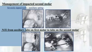 Management of impacted second molar
 Severely tipped teeth – auxiliary spring
NiTi from auxiliary tube on first molar to tube on the second molar
34
 