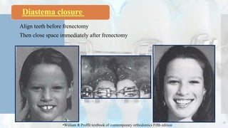 Align teeth before frenectomy
Then close space immediately after frenectomy
35
•Wiiliam R Proffit textbook of comtemporary orthodontics Fifth edition
Diastema closure
 