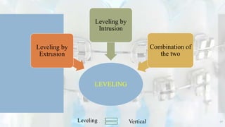 LEVELING
Leveling by
Extrusion
Leveling by
Intrusion
Combination of
the two
Leveling Vertical 40
 