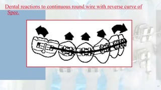 Dental reactions to continuous round wire with reverse curve of
Spee.
42
 