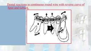 Dental reactions to continuous round wire with reverse curve of
Spee and tieback.
43
 