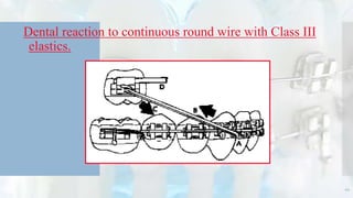 Dental reaction to continuous round wire with Class III
elastics.
44
 
