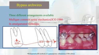  Three different arrangements available
1. Mulligan common sense mechanics(JCO 1980
2. In amalgamated technique
46
Bypass archwires
•Wiiliam R Proffit textbook of comtemporary orthodontics Fifth edition
 