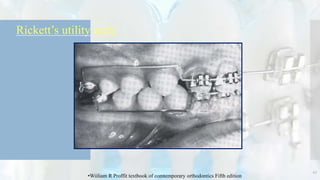  Rickett’s utility arch
47
•Wiiliam R Proffit textbook of comtemporary orthodontics Fifth edition
 