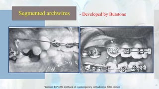50
Segmented archwires - Developed by Burstone
•Wiiliam R Proffit textbook of comtemporary orthodontics Fifth edition
 