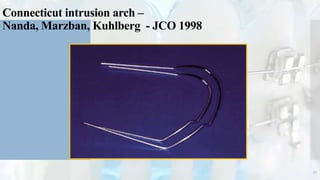 Connecticut intrusion arch –
Nanda, Marzban, Kuhlberg - JCO 1998
51
 