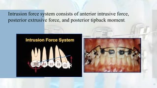 Intrusion force system consists of anterior intrusive force,
posterior extrusive force, and posterior tipback moment.
52
 