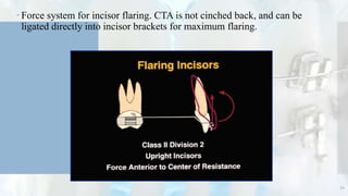  Force system for incisor flaring. CTA is not cinched back, and can be
ligated directly into incisor brackets for maximum flaring.
54
 