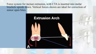  Force system for incisor extrusion, with CTA is inserted into molar
brackets upside down. Vertical forces shown are ideal for correction of
minor open bites.
55
 