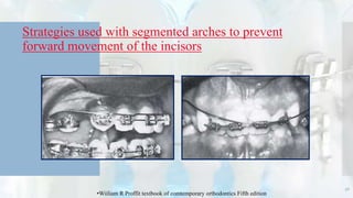 Strategies used with segmented arches to prevent
forward movement of the incisors
56
•Wiiliam R Proffit textbook of comtemporary orthodontics Fifth edition
 