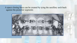 A space closing force can be created by tying the auxillary arch back
against the posterior segments
57
 