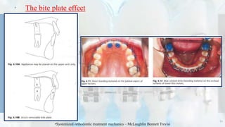 61
 The bite plate effect
•Systemized orthodontic treatment mechanics – McLaughlin Bennett Trevisi
 