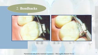 65
2. Bendbacks
•Systemized orthodontic treatment mechanics – McLaughlin Bennett Trevisi
 