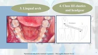 66
3. Lingual arch
4. Class III elastics
and headgear
•Systemized orthodontic treatment mechanics – McLaughlin Bennett Trevisi
 