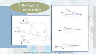 67
5. Head gear for
upper molars
•Systemized orthodontic treatment mechanics – McLaughlin Bennett Trevisi
 