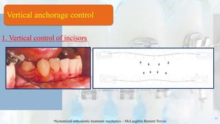 1. Vertical control of incisors
68
•Systemized orthodontic treatment mechanics – McLaughlin Bennett Trevisi
Vertical anchorage control
 