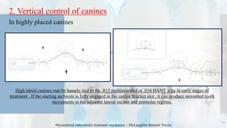 2. Vertical control of canines
In highly placed canines
69
•Systemized orthodontic treatment mechanics – McLaughlin Bennett Trevisi
High labial canines mat be loosely tied to the .015 multistranded or .016 HANT wire in early stages of
treatment . If the starting archwire is fully engaged in the canine bracket slot , it can produce unwanted tooth
movements in the adjacent lateral incisor and premolar regions.
 