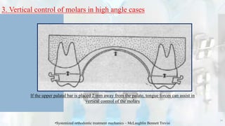 3. Vertical control of molars in high angle cases
70
•Systemized orthodontic treatment mechanics – McLaughlin Bennett Trevisi
If the upper palatal bar is placed 2 mm away from the palate, tongue forces can assist in
vertical control of the molars
 