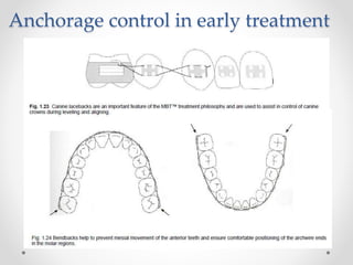 Anchorage control in early treatment
 