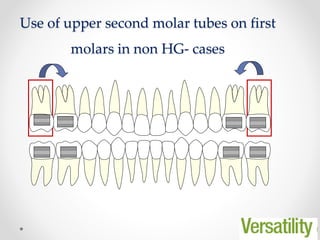 53
Use of upper second molar tubes on first
molars in non HG- cases
 