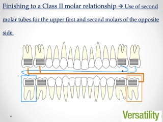 54
Finishing to a Class II molar relationship  Use of second
molar tubes for the upper first and second molars of the opposite
side.
.
 