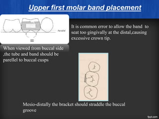Upper first molar band placement
When viewed from buccal side
,the tube and band should be
parellel to buccal cusps
It is common error to allow the band to
seat too gingivally at the distal,causing
excessive crown tip.
Mesio-distally the bracket should straddle the buccal
groove
 