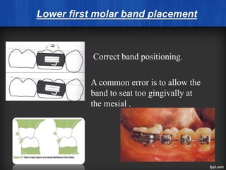 Lower first molar band placement
Correct band positioning.
A common error is to allow the
band to seat too gingivally at
the mesial .
 