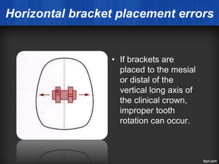 Horizontal bracket placement errors
• If brackets are
placed to the mesial
or distal of the
vertical long axis of
the clinical crown,
improper tooth
rotation can occur.
 