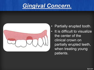 Gingival Concern.
• Partially erupted tooth.
• It is difficult to visualize
the center of the
clinical crown on
partially erupted teeth,
when treating young
patients.
 