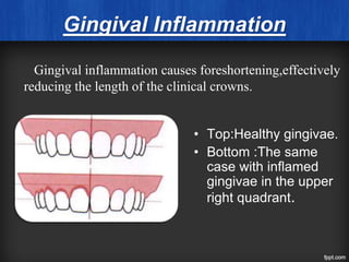 Gingival Inflammation
• Top:Healthy gingivae.
• Bottom :The same
case with inflamed
gingivae in the upper
right quadrant.
Gingival inflammation causes foreshortening,effectively
reducing the length of the clinical crowns.
 
