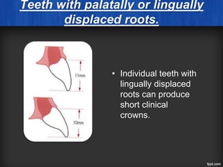 Teeth with palatally or lingually
displaced roots.
• Individual teeth with
lingually displaced
roots can produce
short clinical
crowns.
 