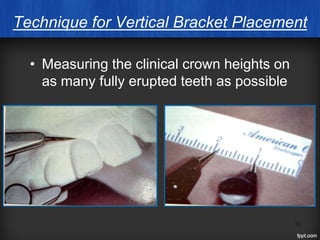71
Technique for Vertical Bracket Placement
• Measuring the clinical crown heights on
as many fully erupted teeth as possible
 