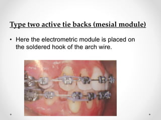 Type two active tie backs (mesial module)
• Here the electrometric module is placed on
the soldered hook of the arch wire.
 