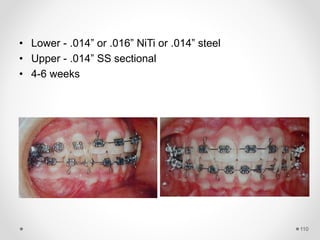 110
• Lower - .014” or .016” NiTi or .014” steel
• Upper - .014” SS sectional
• 4-6 weeks
 