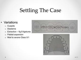111
Settling The Case
• Variations
o Cuspids
o Diastema
o Extraction – fig 8 ligatures
o Palatal expansion
o Mod to severe Class II/1
 