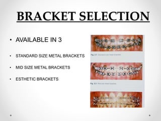 BRACKET SELECTION
• AVAILABLE IN 3
• STANDARD SIZE METAL BRACKETS
• MID SIZE METAL BRACKETS
• ESTHETIC BRACKETS
 