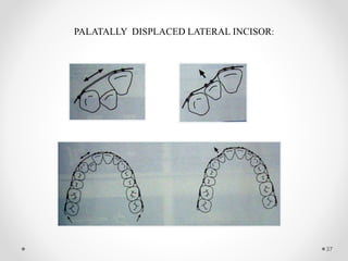PALATALLY DISPLACED LATERAL INCISOR:
37
 