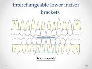 Interchangeable lower incisor
brackets
39
Interchangeable
 