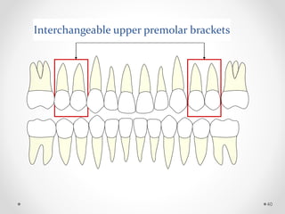 Interchangeable upper premolar brackets
40
 
